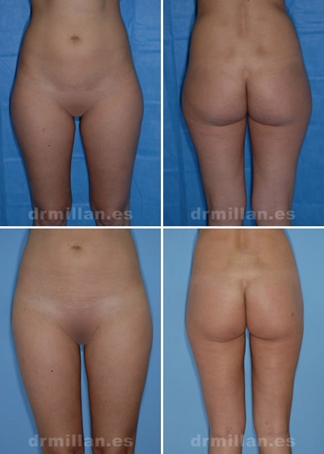 antes y despues de la liposuccion