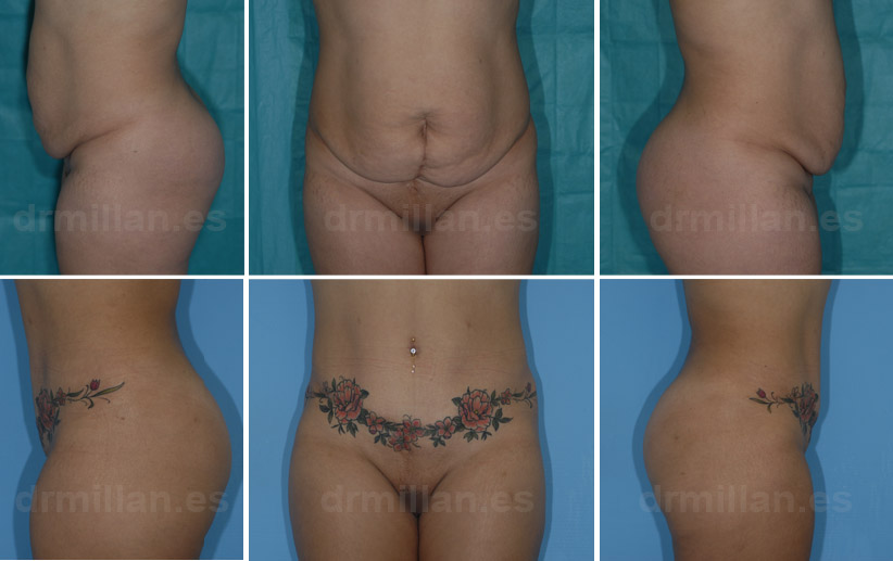 Abdominoplastia y reconstrucción musculatura abdomen en Madrid
