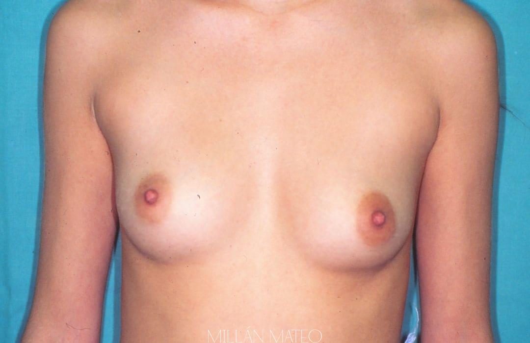 SaraS (asimetría mamaria)